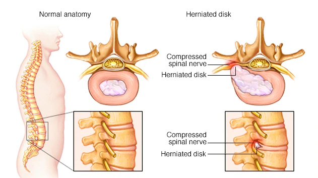 Disco Herniado